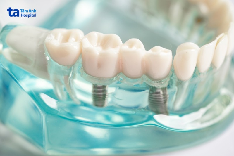 Điều trị mất răng do răng lung lay