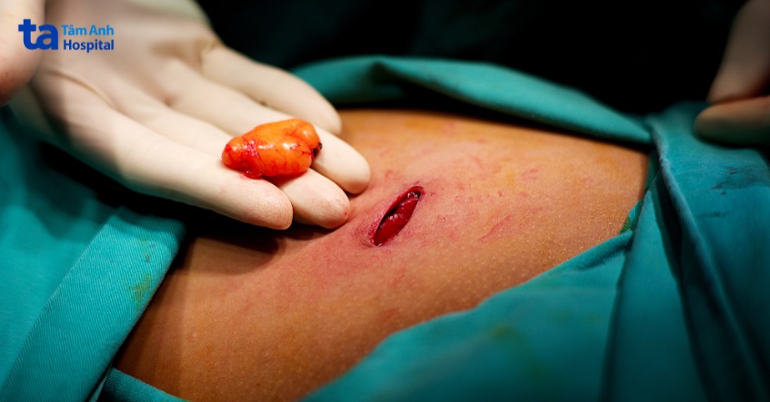 điều trị u mỡ dưới da