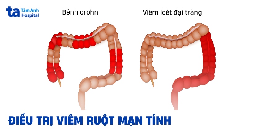 điều trị viêm ruột mạn tính