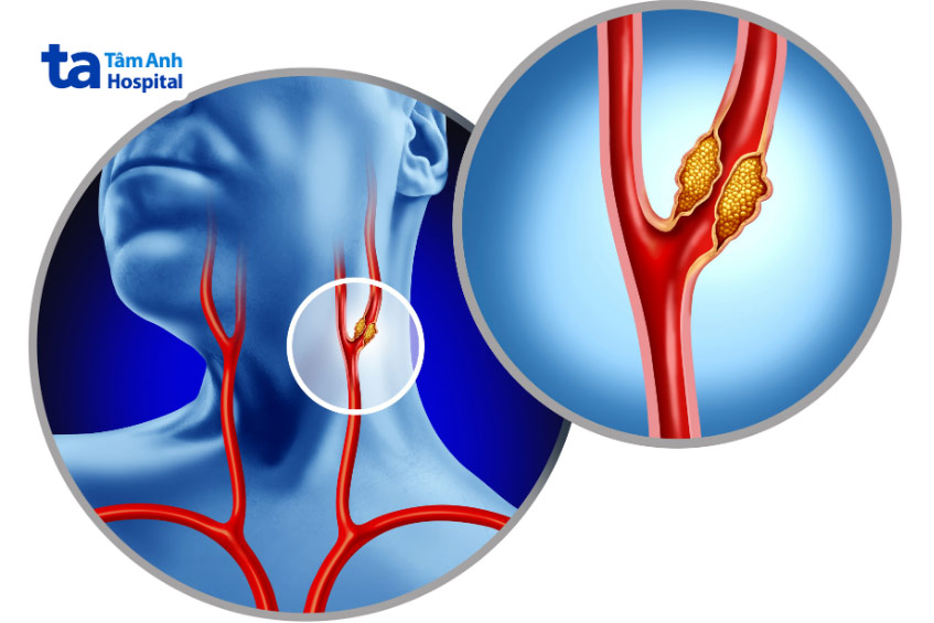 Động mạch cảnh bị tắc nghẽn do tích tụ mảng xơ vữa