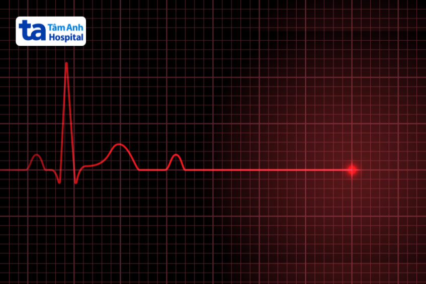 ECG của bệnh nhân đột tử - Nhịp tim ngừng đập (đường thẳng màu đỏ)