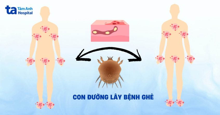 ghẻ có thể lây từ người sang người người