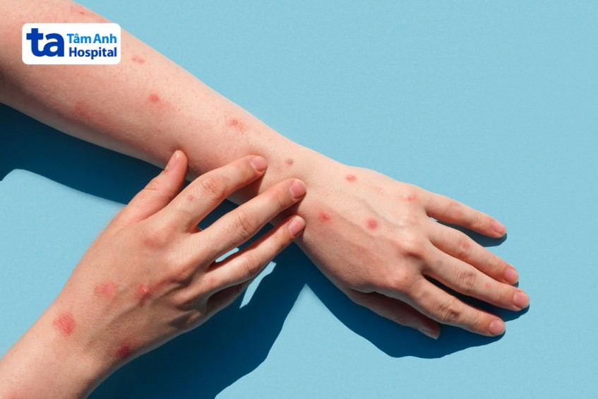 giai đoạn 1 gây sốt cao và phát ban