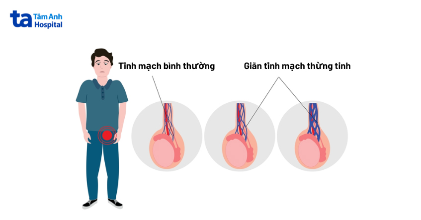 giãn tĩnh mạch thừng tinh