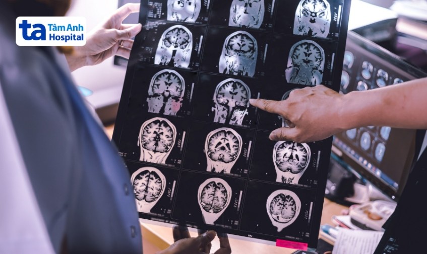 hình ảnh chẩn đoán bệnh teo não