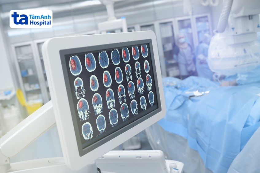 hình ảnh chẩn đoán ung thư não giai đoạn cuối