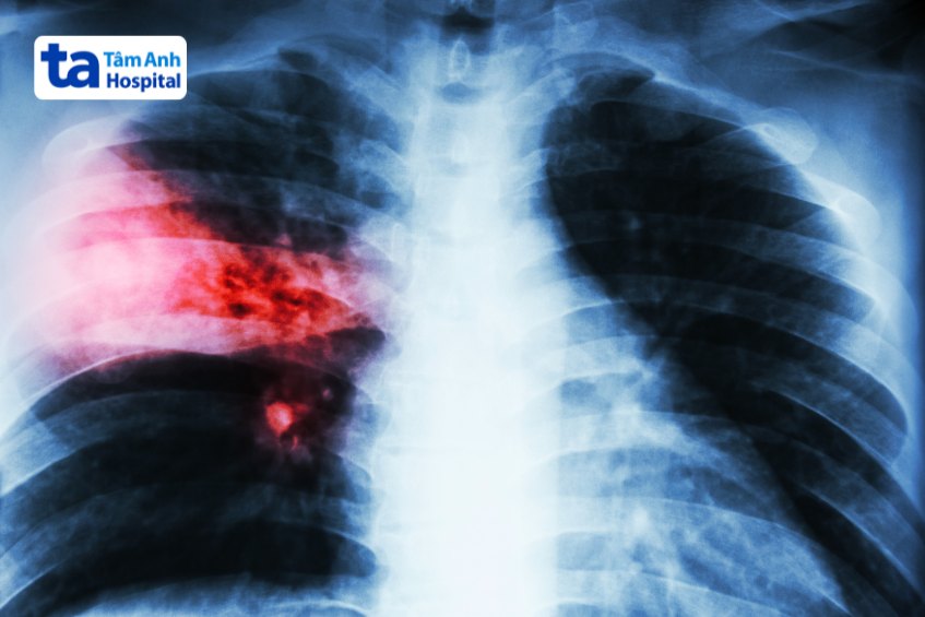 Hình ảnh chụp X-quang cho thấy tình trạng viêm phổi thùy