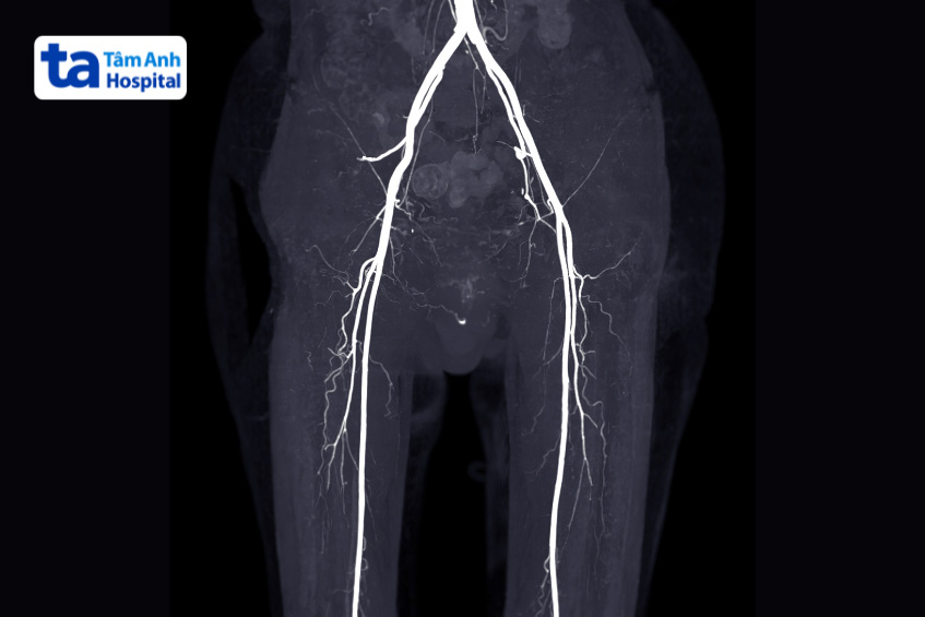 Hình ảnh chụp CT mạch máu ngoại biên chi dưới