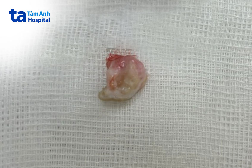 hình ảnh khối u tuyến bã được cắt bỏ