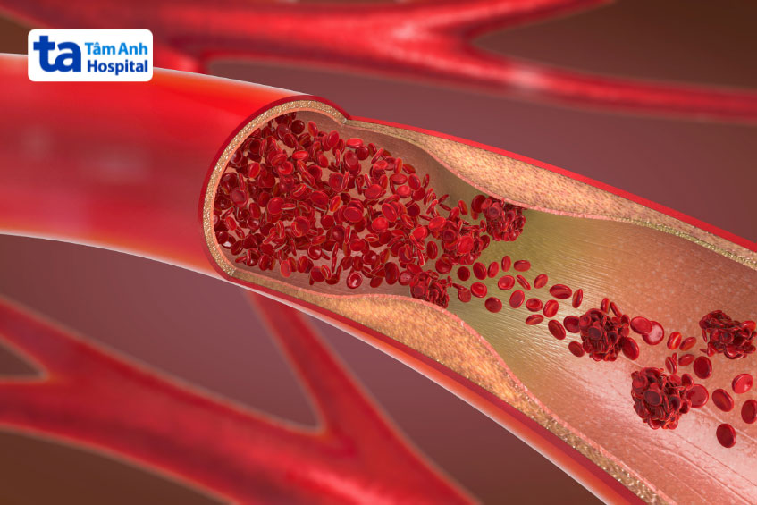 Hình ảnh minh họa động mạch bị tắc nghẽn gây ra bệnh động mạch chi dưới