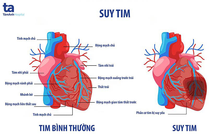Hình ảnh tim bình thường và tim bị suy yếu (suy tim)