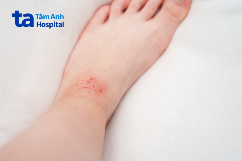 hình ảnh viêm da cơ địa