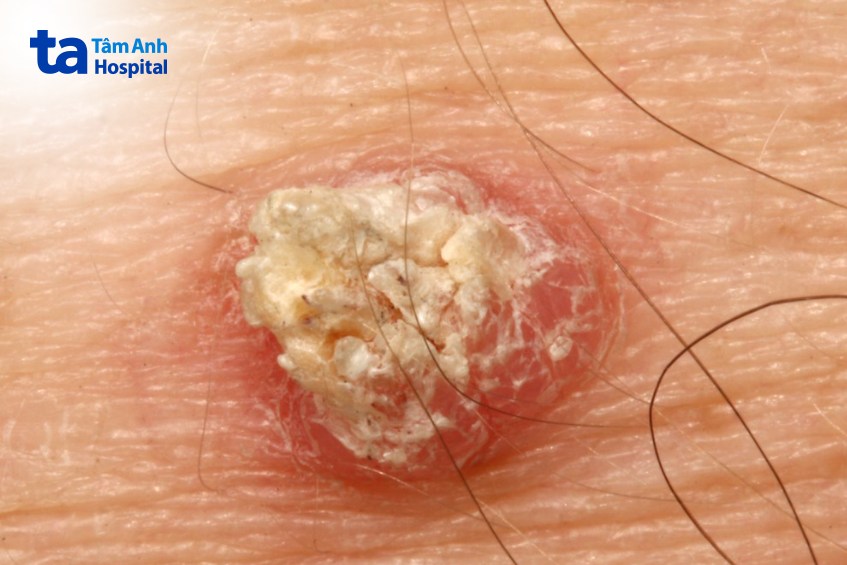hình bệnh ung thư da tế bào vảy