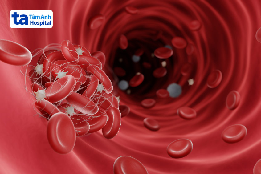 Huyết khối hình thành trong mạch máu