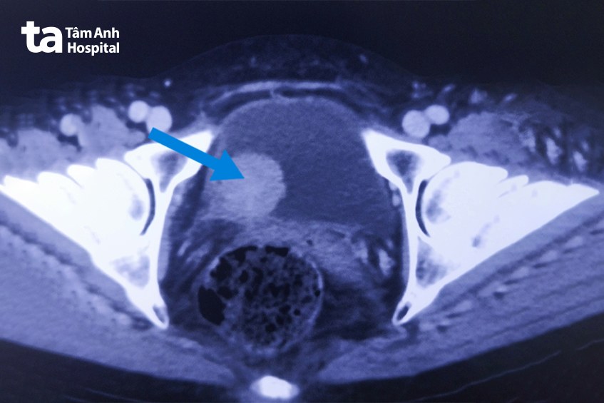 khối u ung thư trong bàng quang