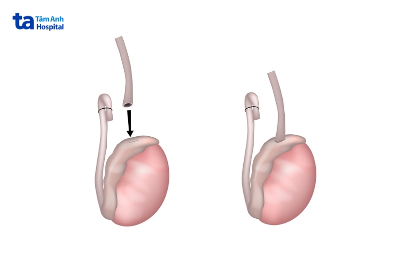kỹ thuật vasoepididymostomy
