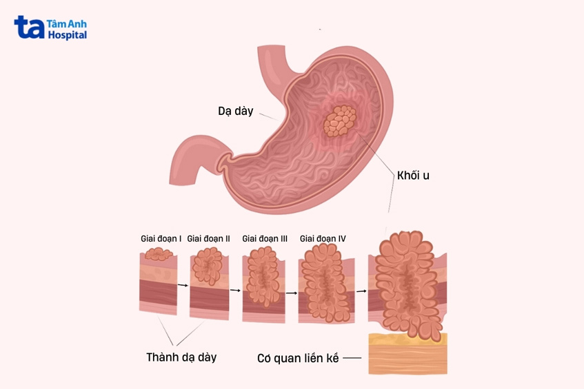 lựa chọn phương pháp điều trị