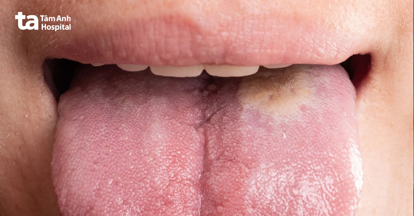 lưỡi có sự thay đổi về màu sắc