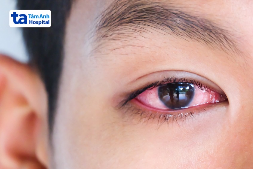 Mắt đỏ, chảy nước mắt do viêm kết mạc