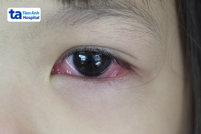 Mắt trẻ sinh đỏ, chảy nhiều dịch do viêm kết mạc