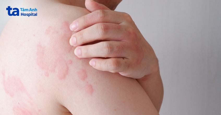 mề đay mạn tính lâu khỏi hơn và thường xuyên tái lại