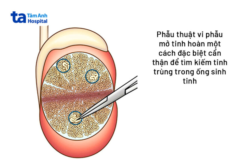 Micro-TESE giúp tìm kiếm và xác định các vùng ống sinh tinh có chứa tinh trùng