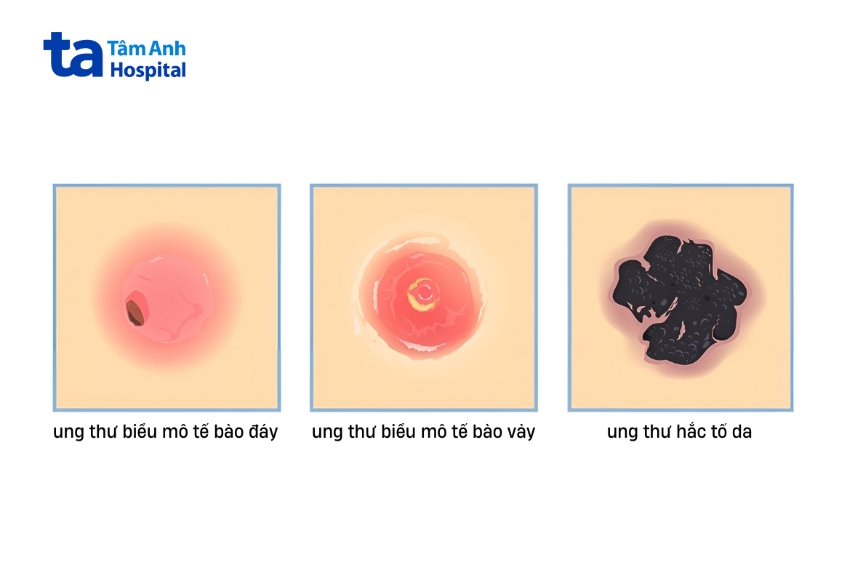 mô phỏng các loại ung thư da phổ biến