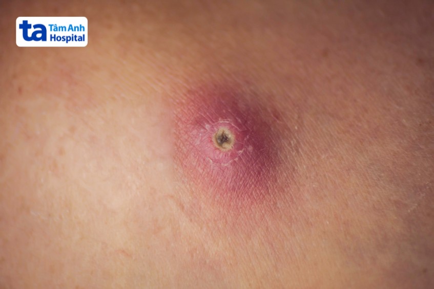 Mụn nhọt là một dạng nhiễm trùng da