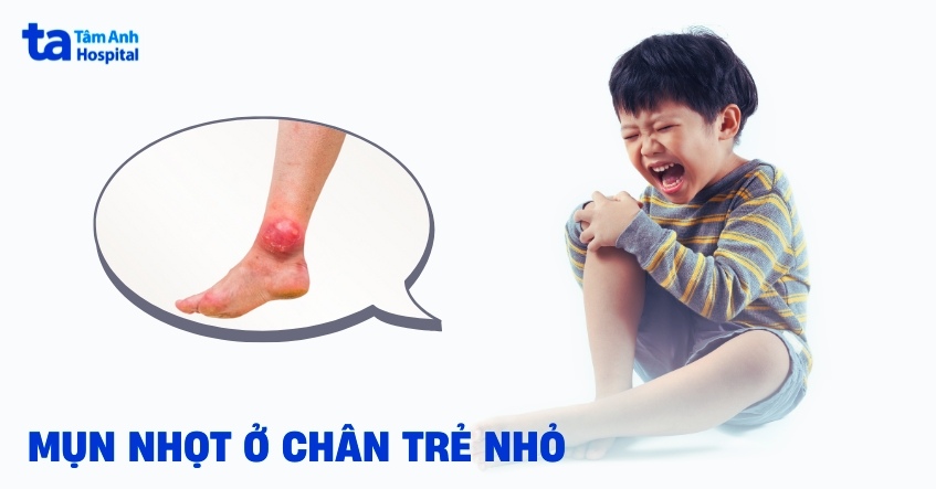 Mụn nhọt ở chân trẻ nhỏ: Nguyên nhân, dấu hiệu và cách điều trị