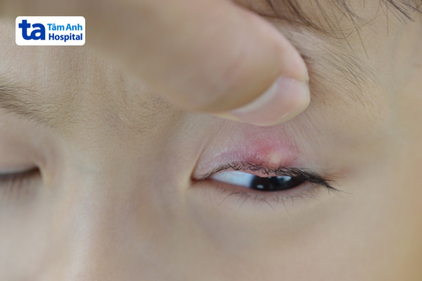 Mụn nhọt xuất hiện ở mí mắt gây khó chịu