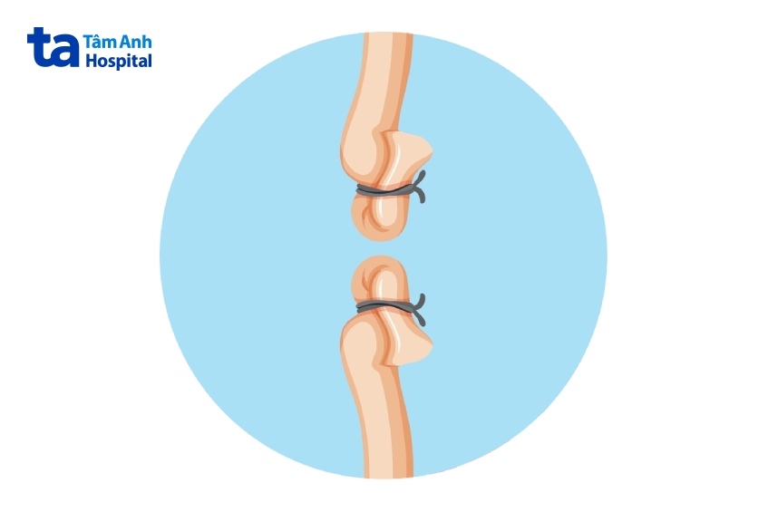 nam giới khi nào thắt ống dẫn tinh