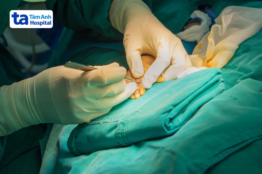 nên thực hiện phẫu thuật cho trẻ từ 6 tháng đến 2 tuổi