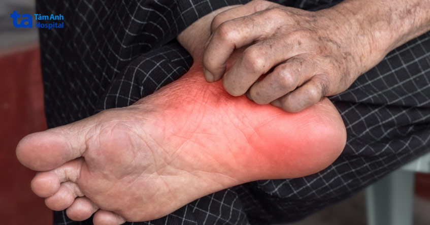 ngứa dữ dội ở vùng da phát ban đặc biệt vào ban đêm