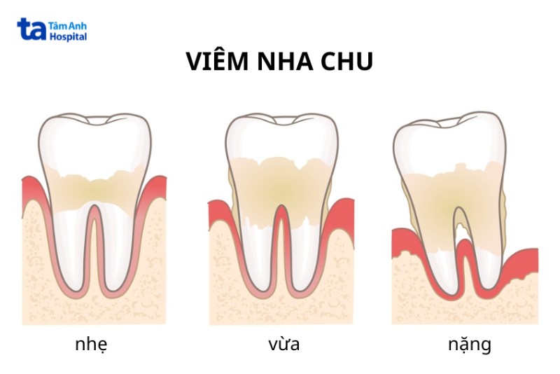 Nguyên nhân răng bị lung lay
