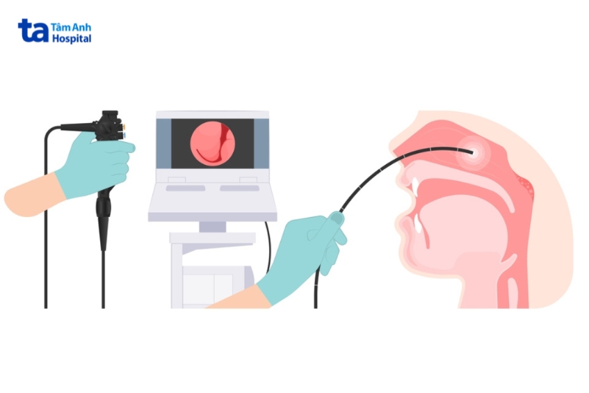nội soi vùng mũi họng để khám ung thư vòm họng