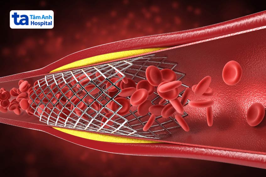 Nong mạch đặt stent là lựa chọn hàng đầu của các bác sĩ khi xử trí các trường hợp nhồi máu cơ tim cấp hoặc tắc hẹp mạch vành