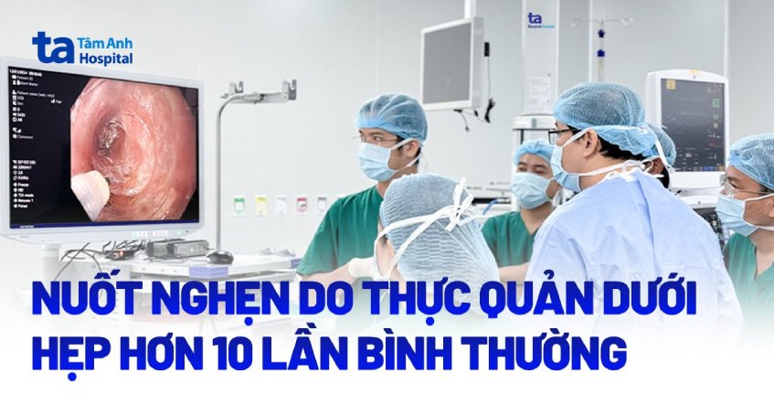 Nuốt nghẹn do thực quản dưới hẹp hơn 10 lần