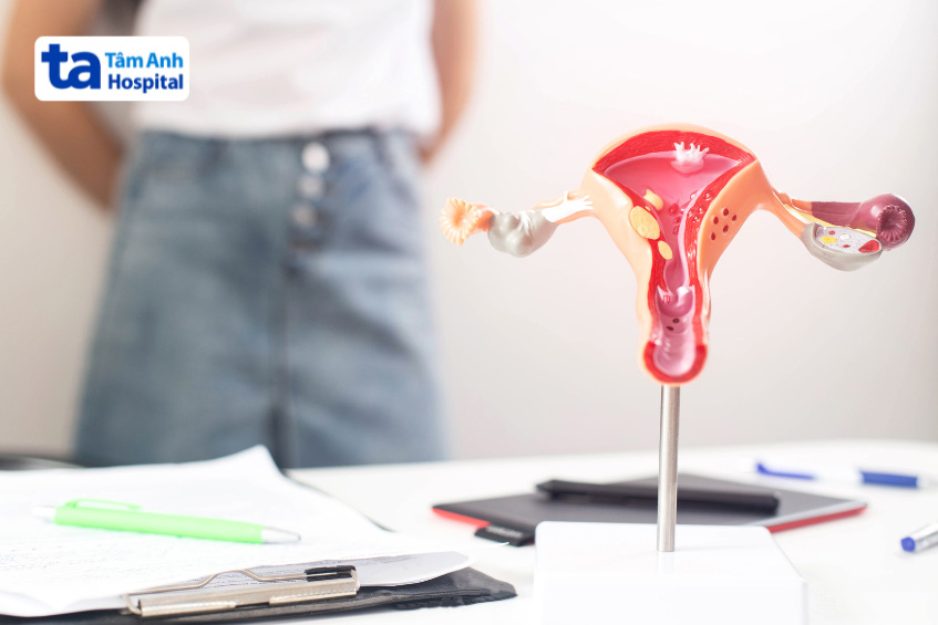 PCOS làm tăng nguy cơ mắc ung thư nội mạc tử cung