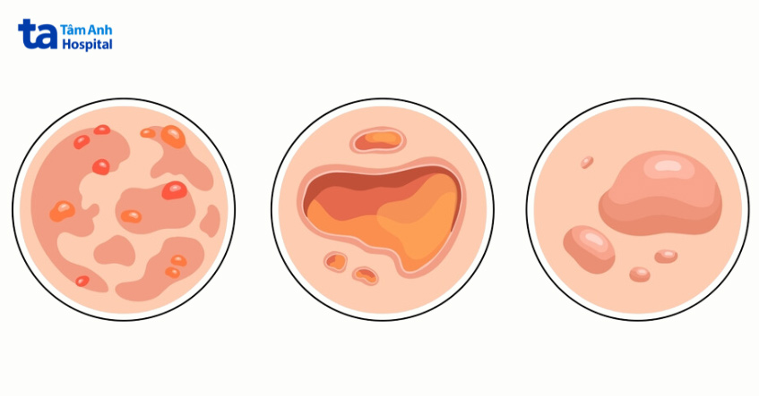 pemphigus là nhóm bệnh rối loạn tự miễn dịch