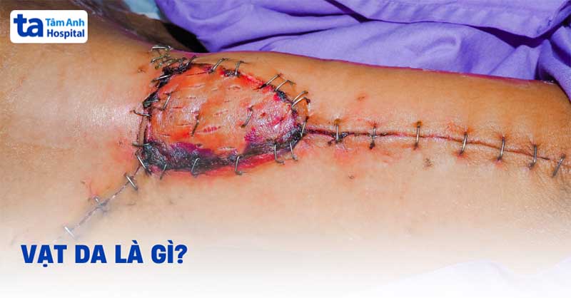 Vạt da là gì? Phẫu thuật chuyển vạt và ứng dụng trong y khoa