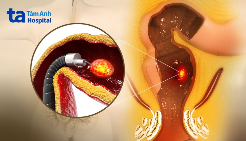 phẫu thuật nội soi để loại bỏ khối ung thư trực tràng