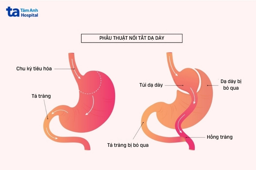 phẫu thuật nối tắt dạ dày