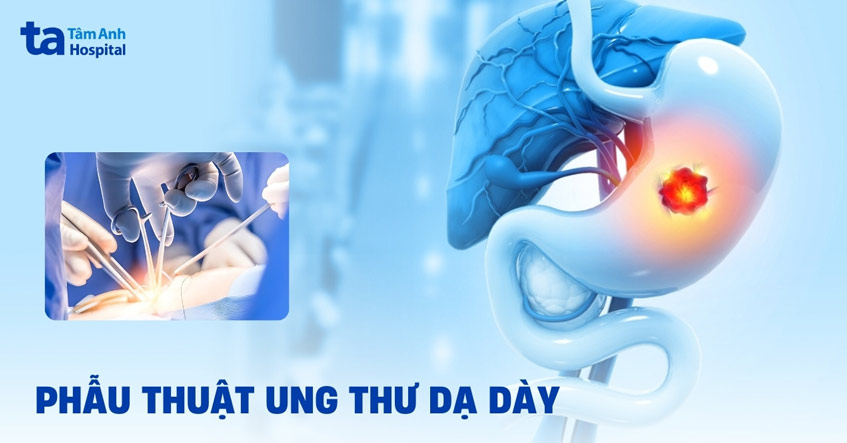 phẫu thuật ung thư dạ dày