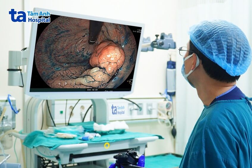polyp lớn ở trực tràng