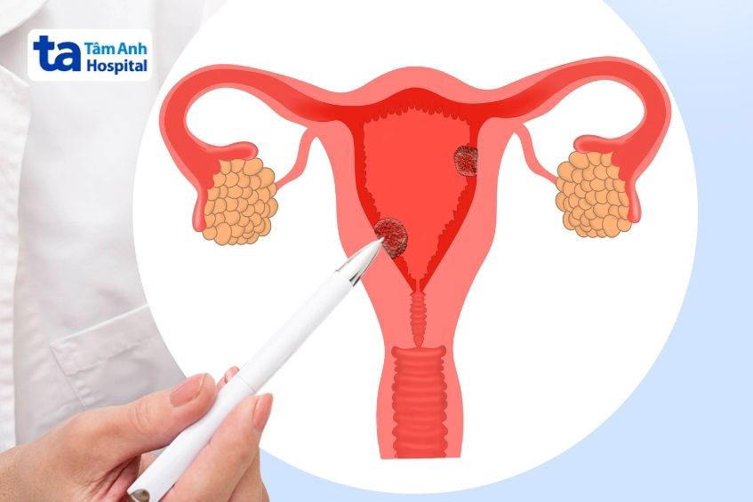 polyp tử cung gây tiết dịch màu nâu ở âm đạo