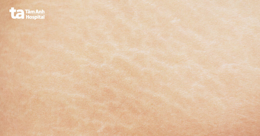 rạn da thường xảy ra ở phụ nữ sau sinh