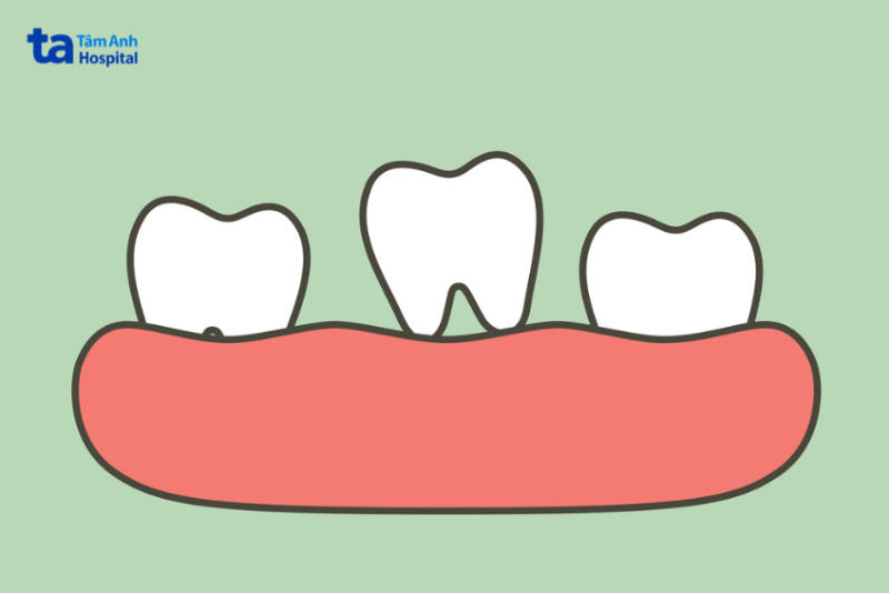 Răng lung lay là gì?