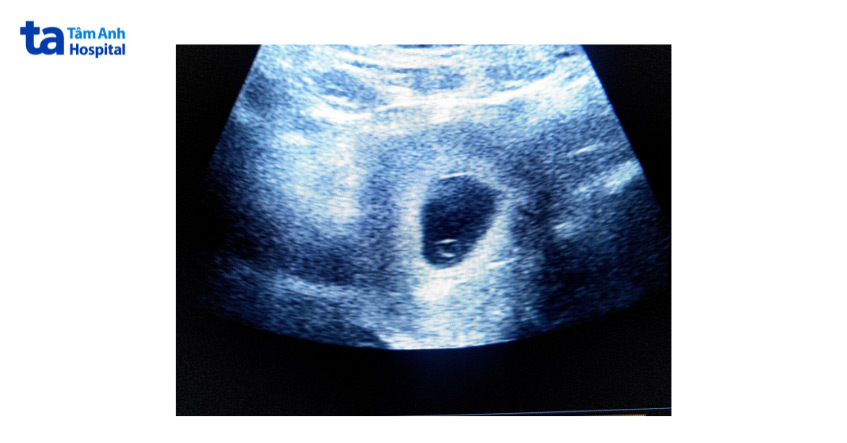 Siêu âm thai tuần thứ 5 giúp xác định túi thai trong tử cung người mẹ