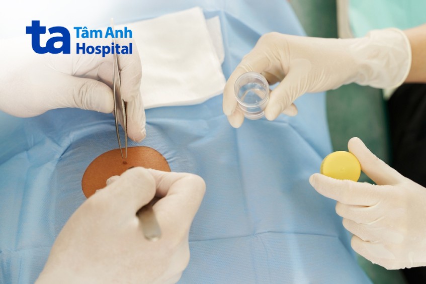 sinh thiết da chẩn đoán bệnh