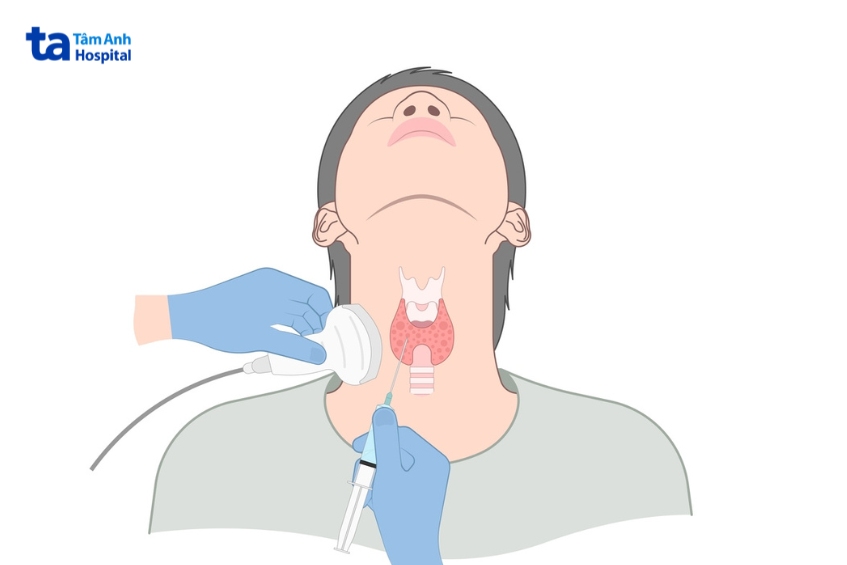 sinh thiết kim nhỏ chẩn đoán ung thư vòm họng